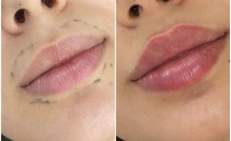 Juvederm Age Gracefully Best Aesthetic Clinic in Dubai