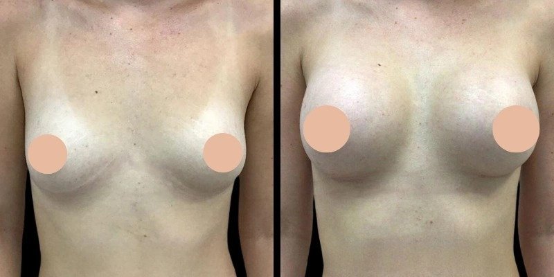 Best Breast Augmentation Surgeon in Dubai: Lifestyle Tips After Breast Augmentation