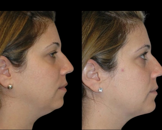 Double chin removal options from Best Doctors in Dubai