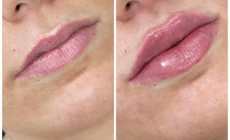 Juvederm First Session Best Doctors in Dubai