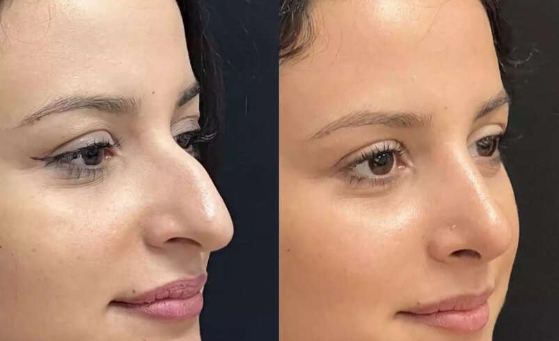 Can Nose Surgery in Dubai Enhance Your Facial Proportions?