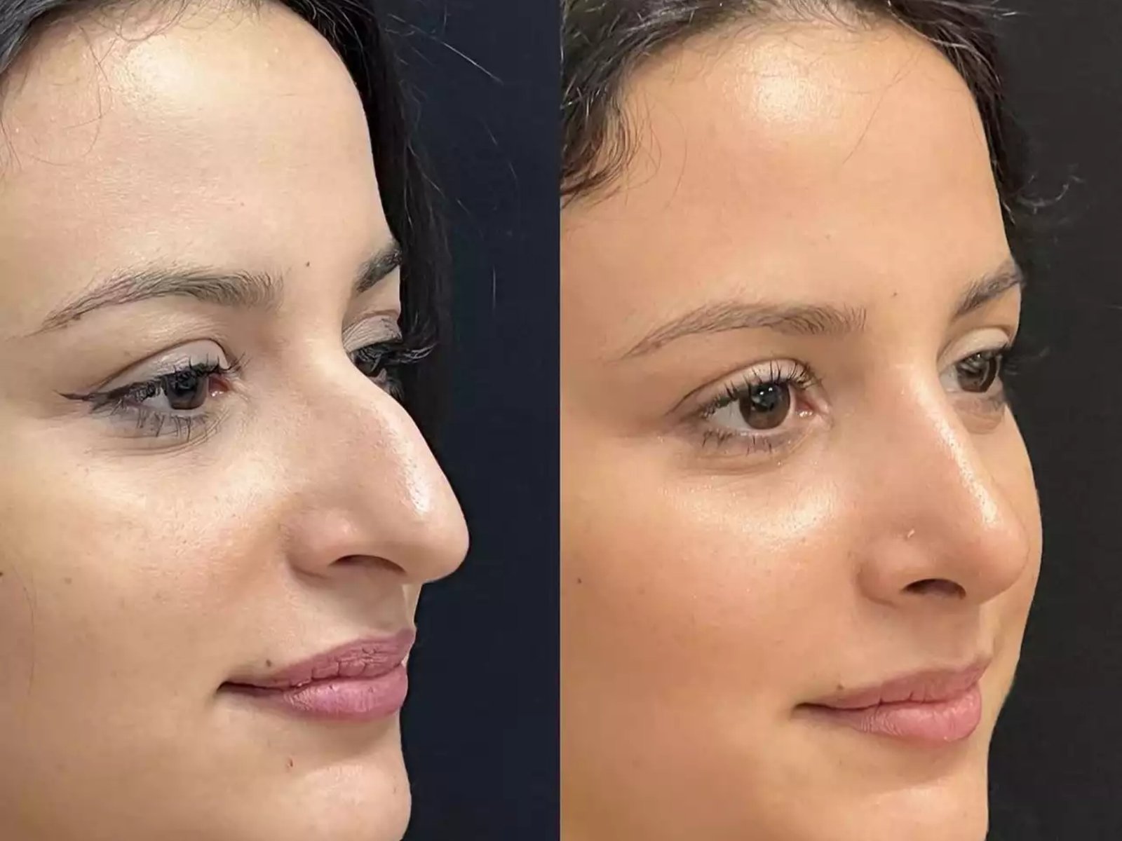 Can Nose Surgery in Dubai Enhance Your Facial Proportions?