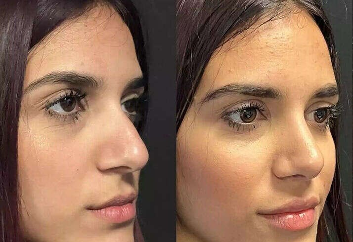 Can Nose Deviated Septum Surgery in Dubai Improve Snoring Problems?