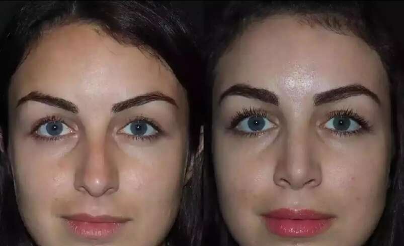 How Long Does Nose Deviated Septum Surgery in Dubai Take to Heal?