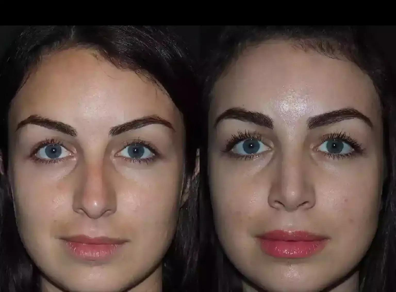 How Long Does Nose Deviated Septum Surgery in Dubai Take to Heal?