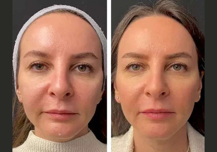 Best Aesthetic Clinics in Dubai for Mesotherapy: Comparing Different Treatment Techniques