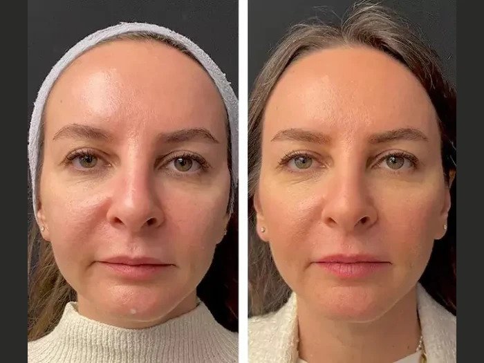 Best Aesthetic Clinics in Dubai for Mesotherapy: Comparing Different Treatment Techniques