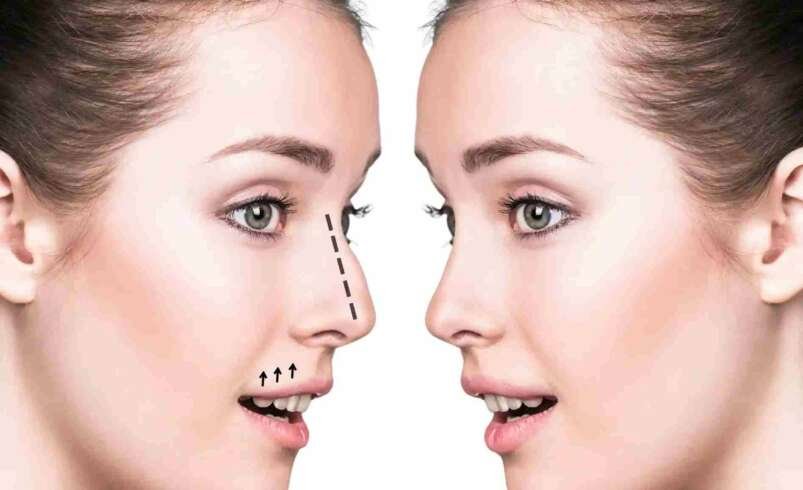 Can Nose Surgery in Dubai Correct Previous Surgical Problems?