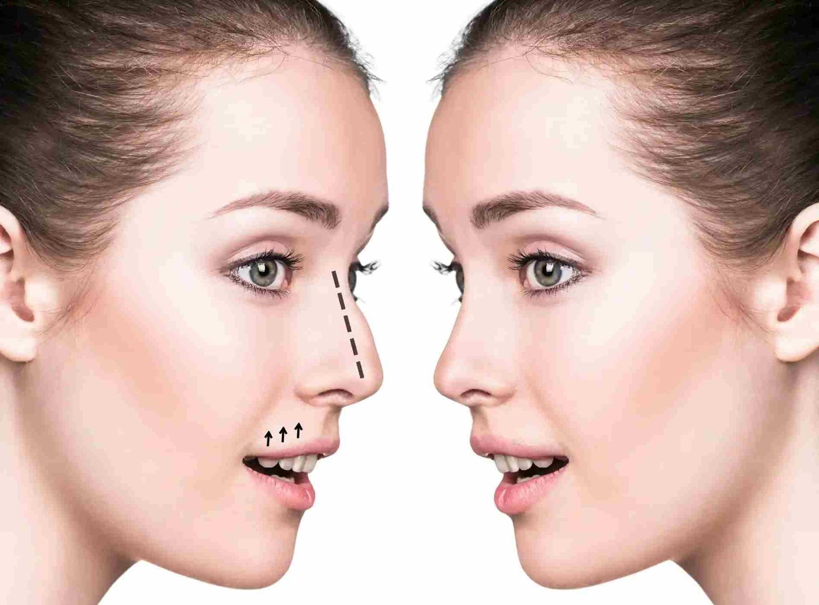 Can Nose Surgery in Dubai Correct Previous Surgical Problems?