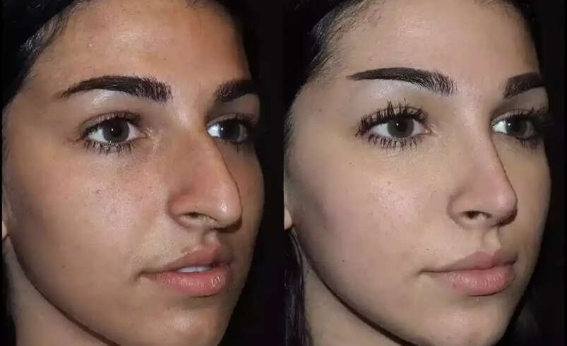 Can Nose Deviated Septum Surgery in Dubai Help Reduce Snoring?