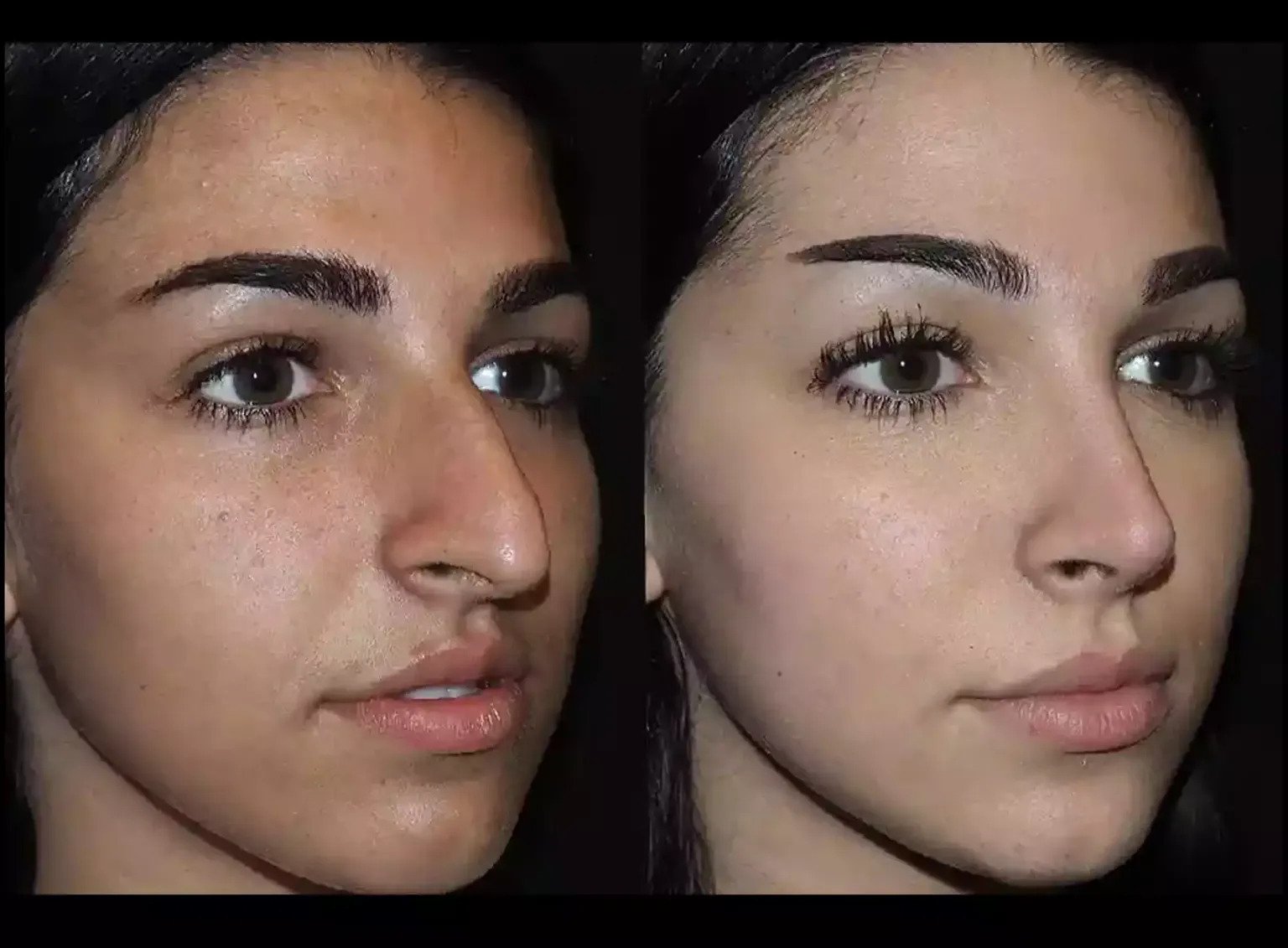Can Nose Deviated Septum Surgery in Dubai Help Reduce Snoring?