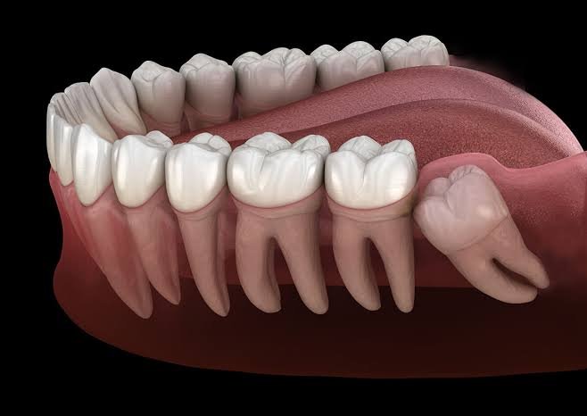 What to Eat After Wisdom Teeth Removal?