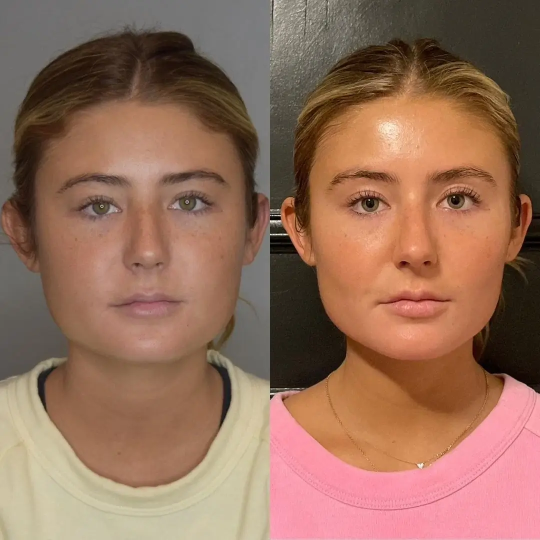 Buccal Fat Removal Safe Procedure Best Doctors in Dubai