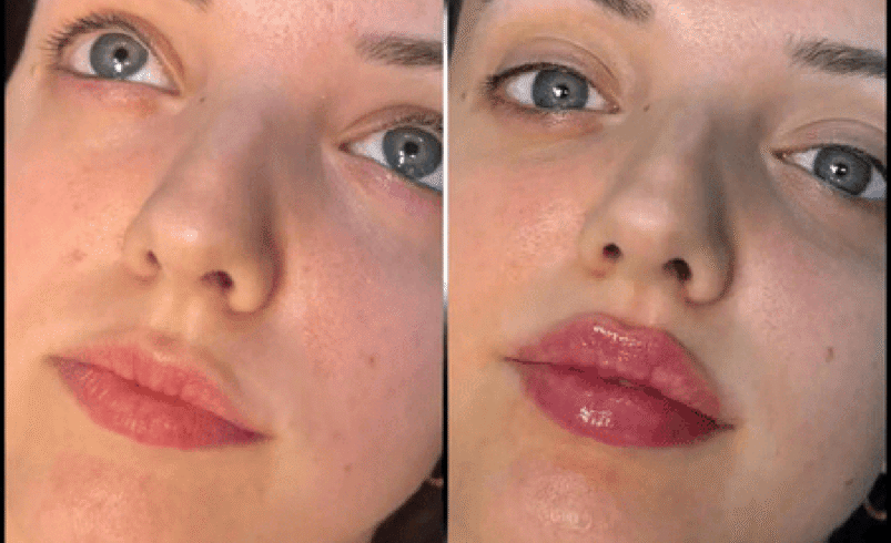 Beauty Enhanced by the Best Aesthetic Clinics in dubai for Fillers