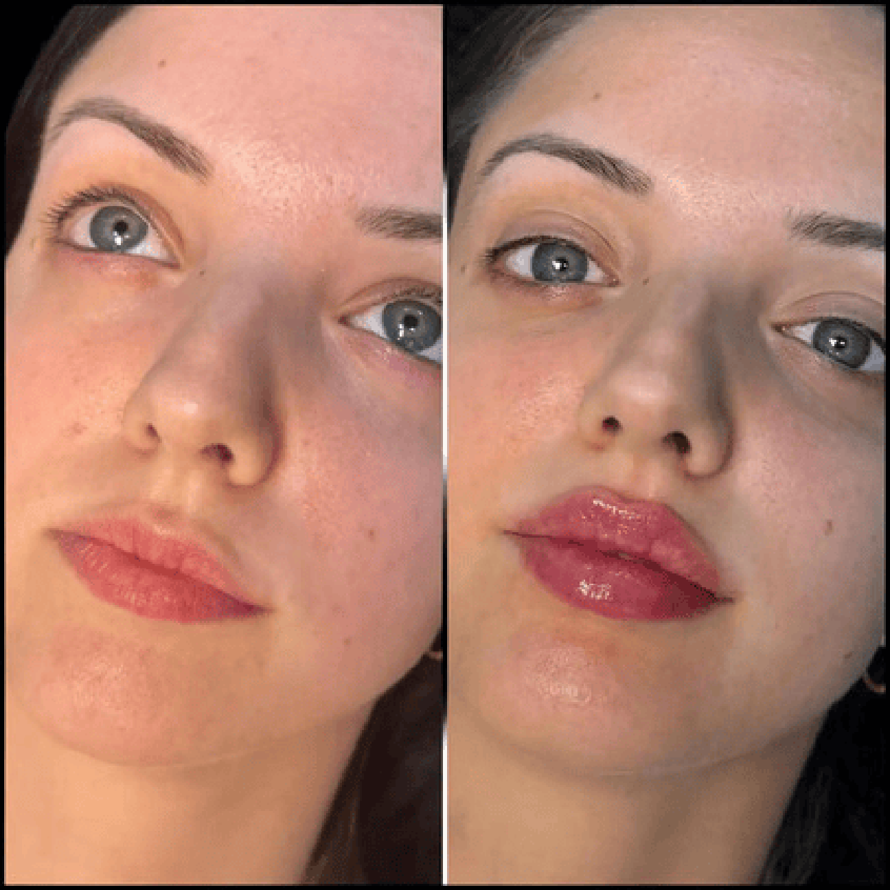 Beauty Enhanced by the Best Aesthetic Clinics in dubai for Fillers