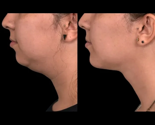 Best Doctors in Dubai master Double chin removal