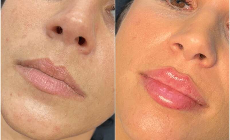 Juvederm Treatments in Dubai Skin Rejuvenation