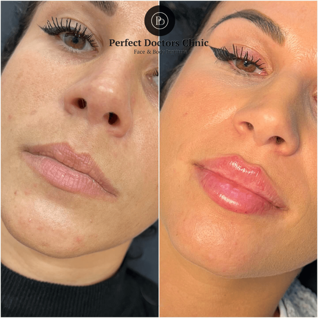 Juvederm Treatments in Dubai Skin Rejuvenation