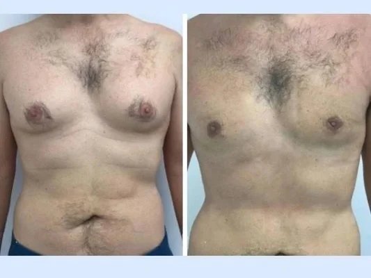 Gynecomastia in Dubai: Treatment and Results