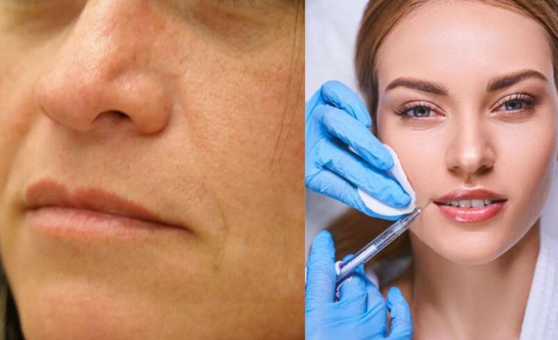Liposuction Surgery in Miami: A Guide to Body Contouring