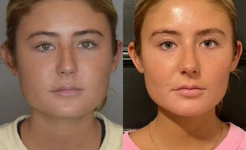 Buccal Fat Removal Surgical Guide Best Doctors in Dubai