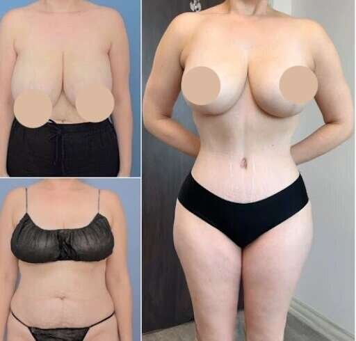Tummy Tuck Surgery in Dubai for Complete Abdominal Rejuvenation