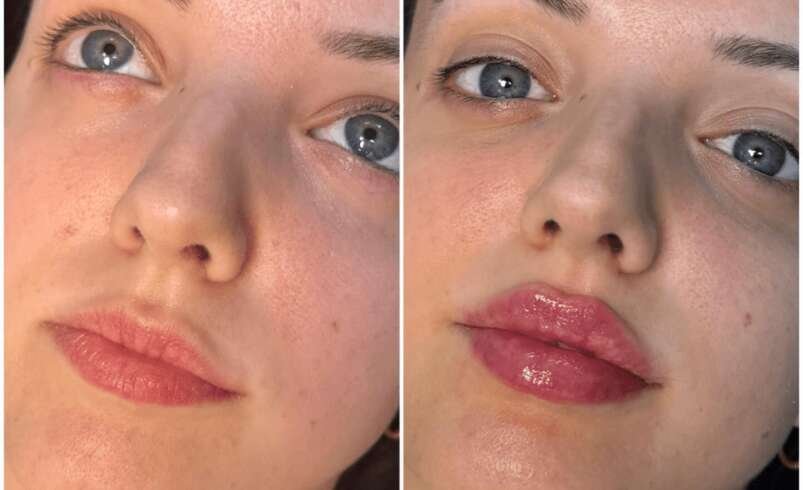 Juvederm in Dubai Safe Injectable Treatments