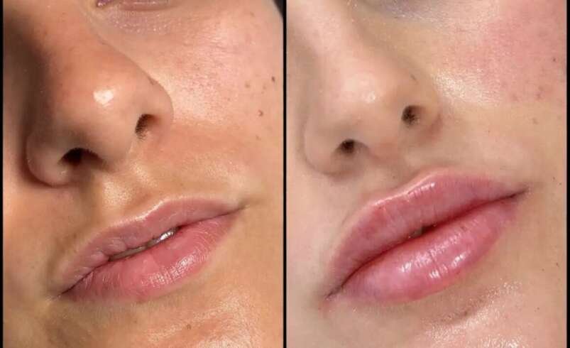 Fillers in Dubai for Youthful and Refreshed Features