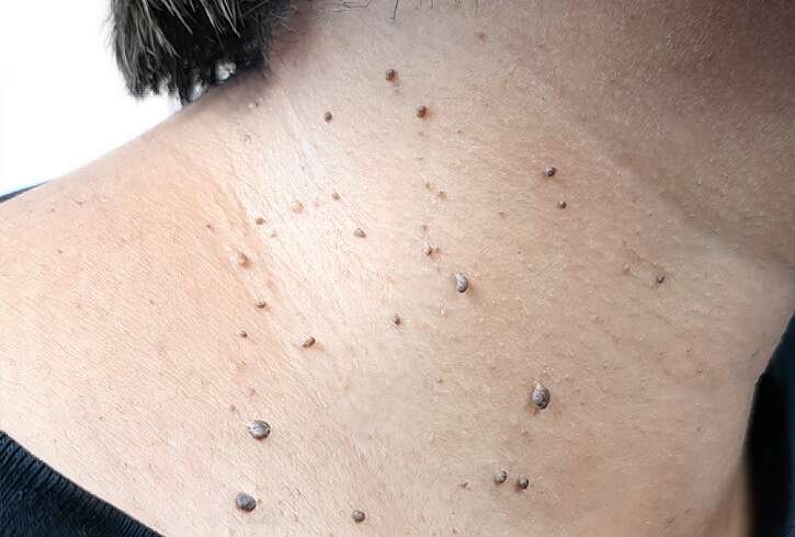 Skin Tag Removal in London: How Are Skin Tags in Sensitive Areas Evaluated Before Treatment?
