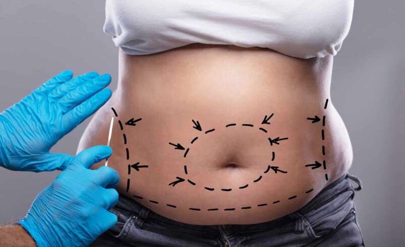 Tummy Tuck Dubai: How to Prepare for Surgery